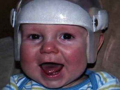 Raleigh infant has skull surgery