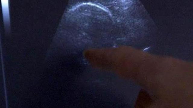 Ultrasound, sonogram, fetus