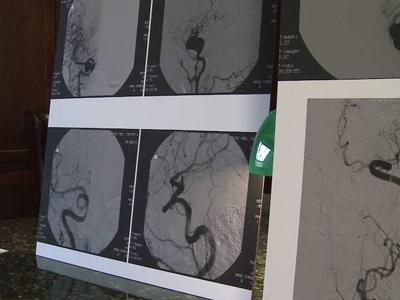 New procedure offers less invasive fix for aneurysms