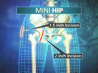 Mini Hip Surgery