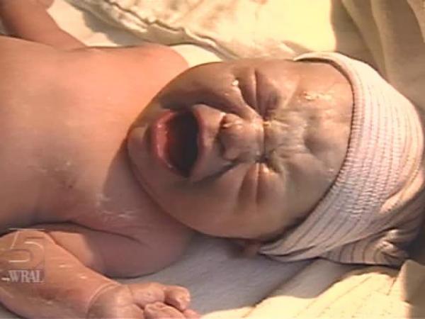 UNC Researchers Find Minor Brain Trauma After Births