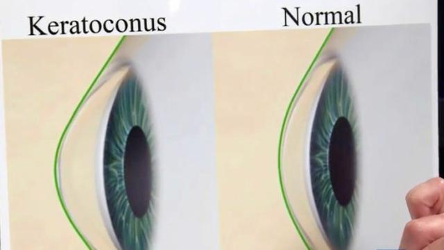Keratoconus changes shape of eye's cornea