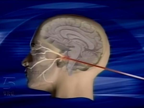 Laser-Guided Procedure Can Zap Away Facial Nerve Pain