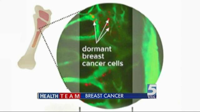 Duke researchers hope to stop breast cancer from returning
