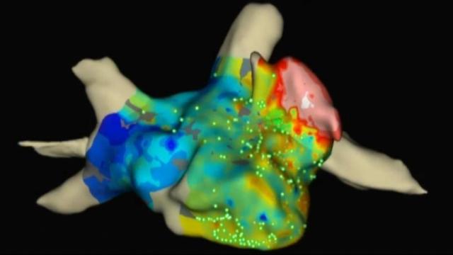 UNC Hospitals among first to offer cardiac mapping