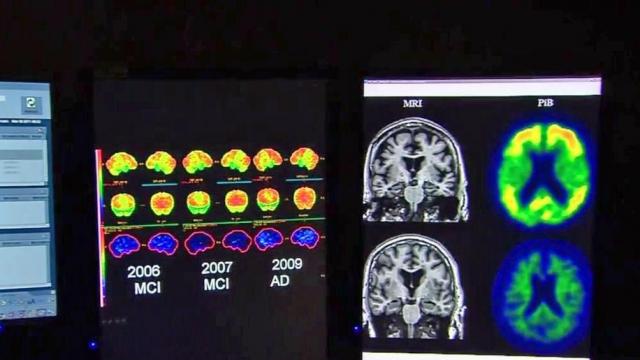 Raleigh company trying different approach with personalized Alzheimer's treatment