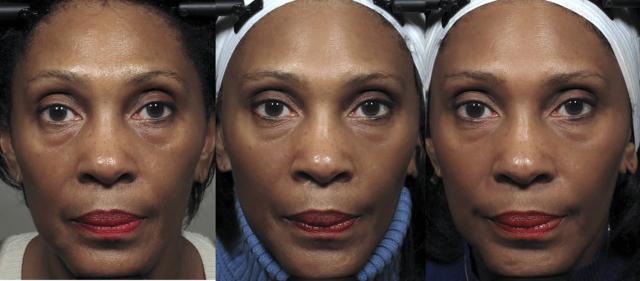 RESTRICTED -- Facial Exercises May Make You Look 3 Years Younger