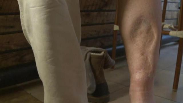 Chef Scott Howell leg after an accident that required at least six surgical procedures.