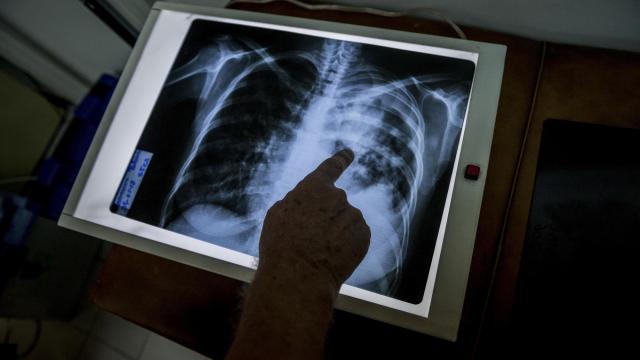 Tuberculosis reported at Durham, Lumberton schools