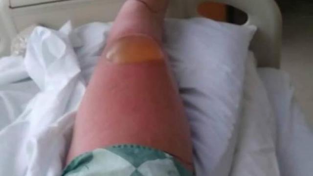 Winston-Salem woman almost loses leg after pedicure