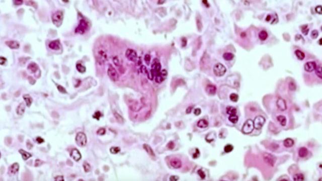 Measles cases nationwide expand, most in 25 years