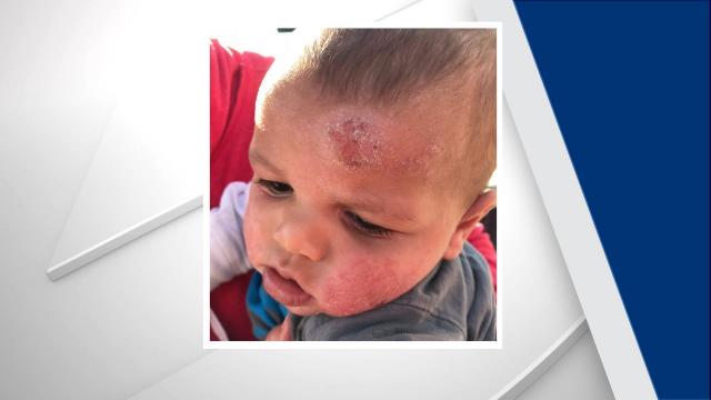 Wake Forest mom says vaccinations not a 'one size fits all' issue after son has serious reaction