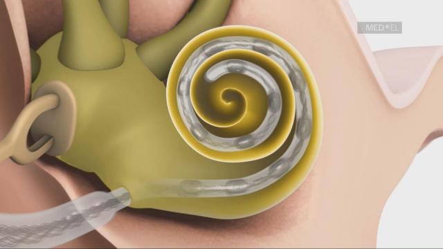 Implants give new hope to people with hearing loss