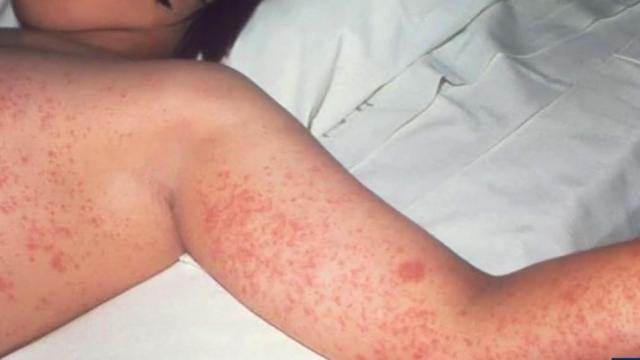 Measles is a renewed global threat after 22 million babies missed their vaccines during the pandemic, CDC warns