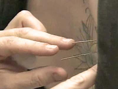 Study: Acupuncture Best for Back Pain