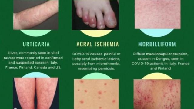 Certain skin rashes emerge as possible coronavirus symptom
