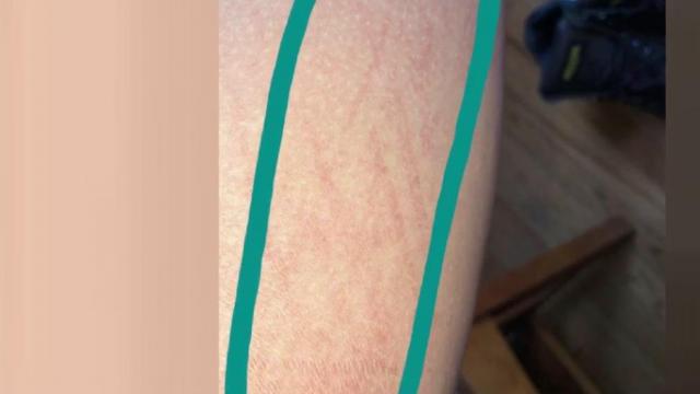 Mother says daughter received chemical burns while swimming in neighborhood pool