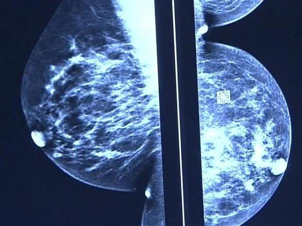 Health Officials: BSGI Breast Cancer Scan is Easier, Less Expensive