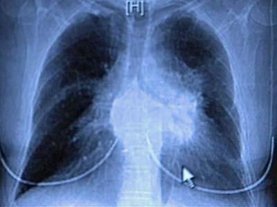 Survivors Raise Awareness of Lung Cancer