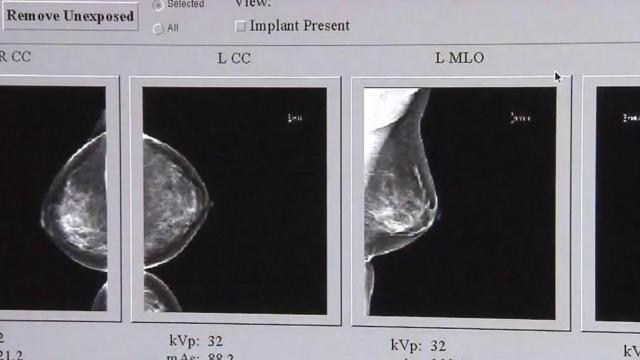 Duke study shows over-diagnosis of breast cancer in older women