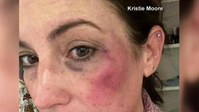 Mother charged after umpire punched in face following softball game