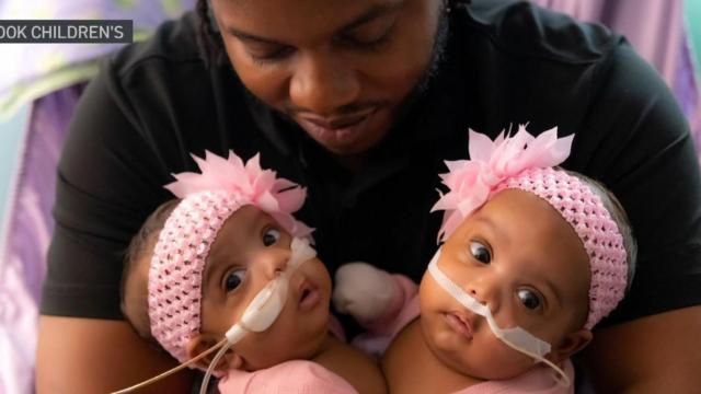 Conjoined twin girls successfully separated at Texas hospital