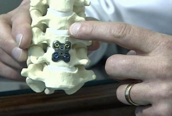 Artificial Disk Can Take Away Neck Pain, Restore Motion
