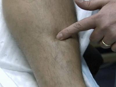 New Procedure Removes Varicose Veins Without Surgery