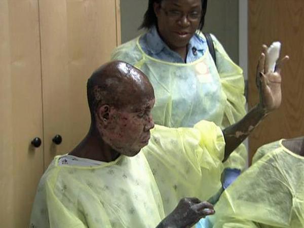 05/01: Haiti burn victim recovering at Chapel Hill Burn Center