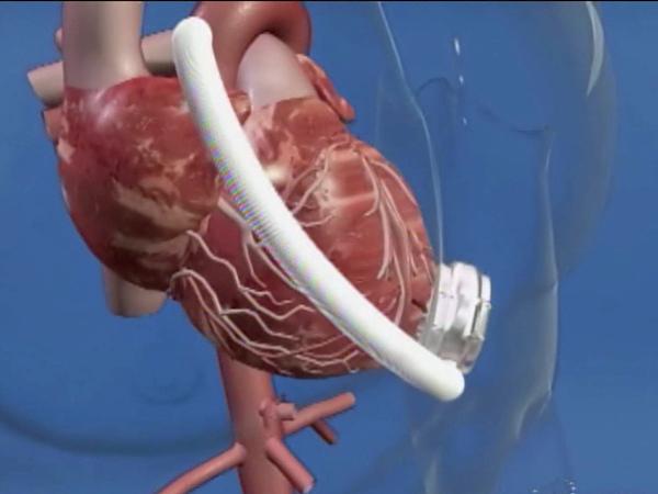 New heart device could replace transplants