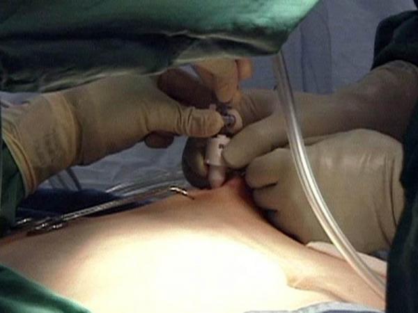 Study: Volume of bariatric surgeries determines complication rate