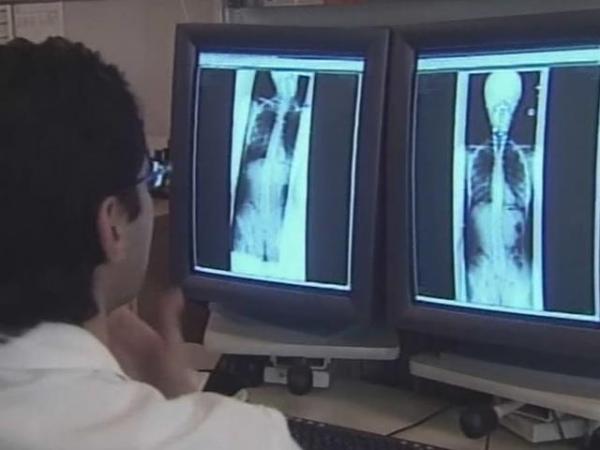 'Vanishing bone disease' has no cure
