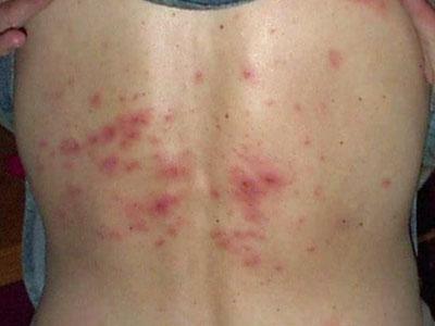 Chicken pox can return in adulthood