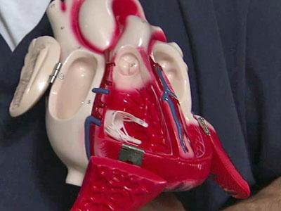 Implant warns before heart attack 